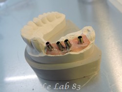 Céramiques sur implants
