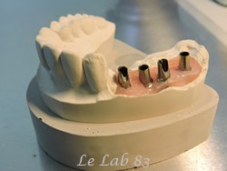 Céramiques sur implants