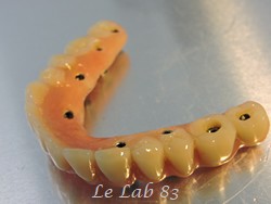Prothèse complète sur implants
