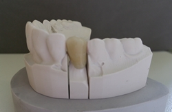 Courone céramo-métallique